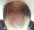 hairline2.png hairline2.png