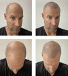 Scalp-stick.jpg