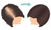 Women-Hair-Transplant.jpg