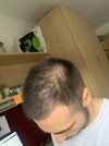 september 2019 prior to finasteride  (1).JPG