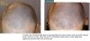 4 Hair loss Progress #2.jpg 4 Hair loss Progress #2.jpg