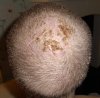 CROWN 2 WEEKS POST OP.jpg