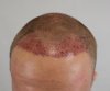 HAIR LINE DAY ONE POST OP.jpg