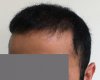 Case 1. 6months-2.jpg