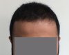 Case 1. 6months-1.jpg