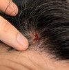 gash-on-head-from-injury-can-it-cause-permanent-hair-loss-v0-9gm7y3udj23f1.jpg