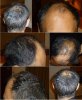 1. Day Before FUE.jpg 1. Day Before FUE.jpg
