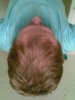 2 months before treatment.jpg