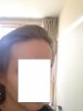 2 years right hairline.jpg