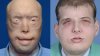 Patrick_Hardison_before_and_after_face_and_hair_transplant.jpg Patrick_Hardison_before_and_after_face_and_hair_transplant.jpg