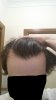 hairloss6.jpg
