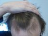 3 both temples 2 month post op.jpg
