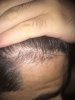 3 Months on Rogain.jpg