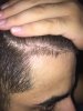 6 Months on Rogain.jpg