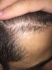 4 Months on Rogain.jpg