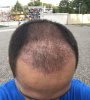 29 days post-op.jpg