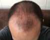 56 days post-op.jpg