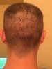 Donor area (8 days post-op).jpg