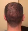 Donor area (22 days post-op).jpg