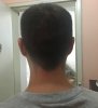 Donor area (37 days post-op).jpg