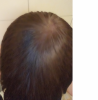 balding 5.png