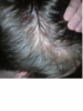 balding 8.png