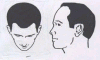 hair_transplant_hair_line.gif