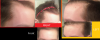 Hairloss.png