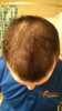 Before Treatment or FUE.jpg