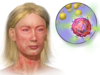 Blausen_0018_Anaphylaxis.png