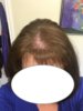 6-5-2017 8 months post op friar tuck mask.jpg