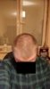 septemper 2017 scalp.jpg