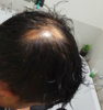 AlopeciaAreata_5_dec_2017.jpg