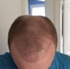 5 months post.jpg