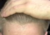 Hairline.jpg