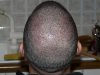 2 days after beard hairs in recipient area.jpg