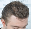 hairline2.png