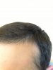 hairline 10 weeks.jpg hairline 10 weeks.jpg