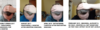 hairline2.png