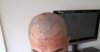 PRE OP - Hairline.jpg