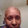 Alopecia to Afro