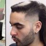 Left4bald