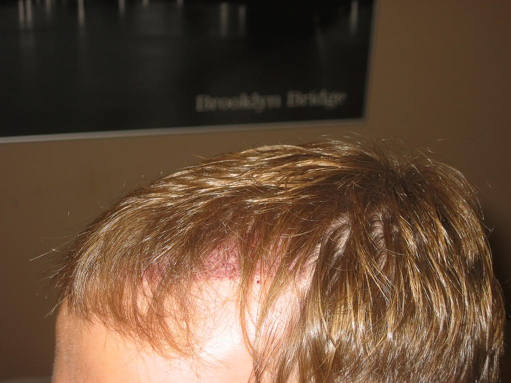 FUEWASHED1STTIMEDAYAFTERSIDELEFT.jpg