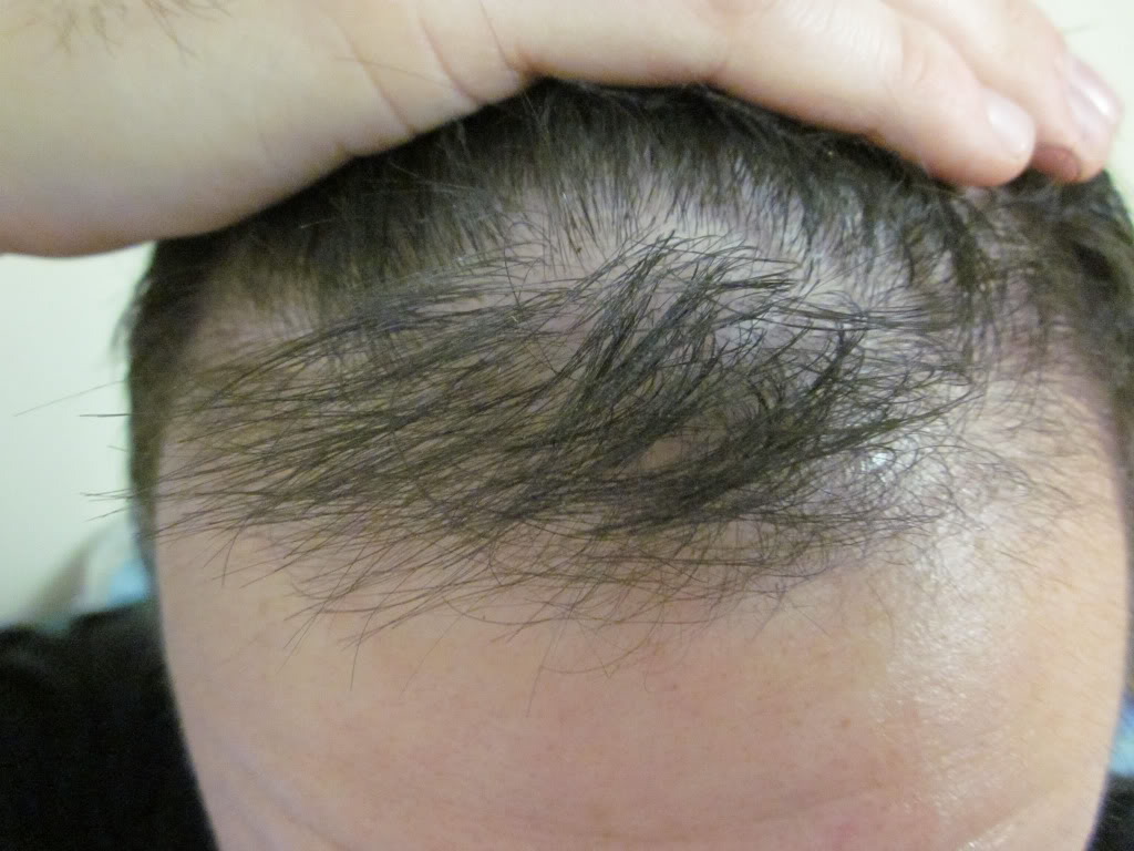 hairloss02.jpg
