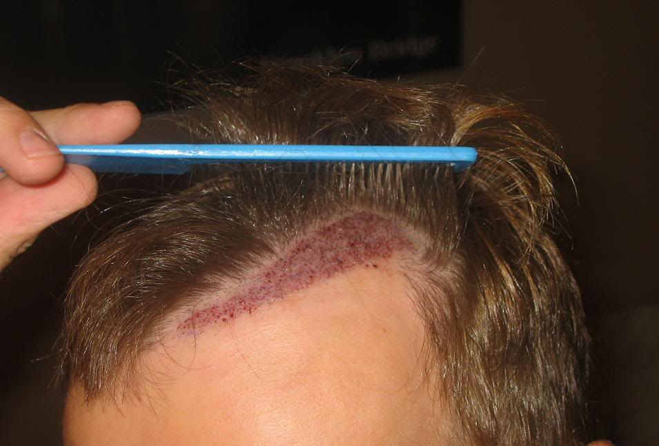 FUEWASHED1STTIMEDAYAFTERPULLEDBACK.jpg