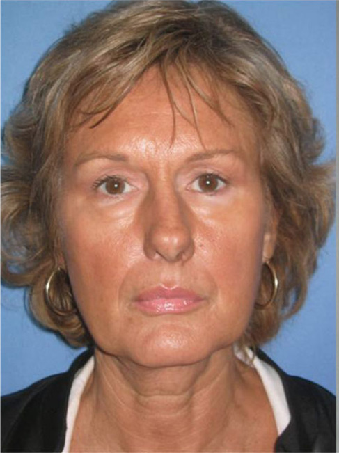 facelift_3a_0.jpg