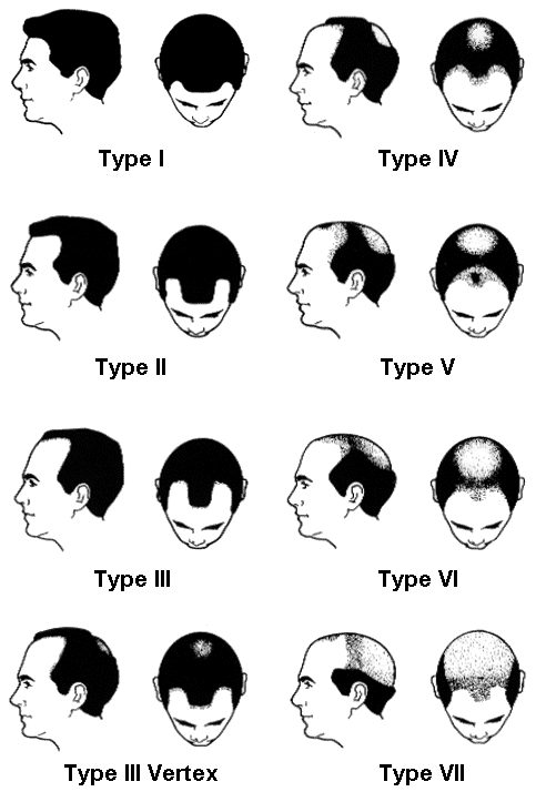 Norwood%20Chart%20Balding.gif