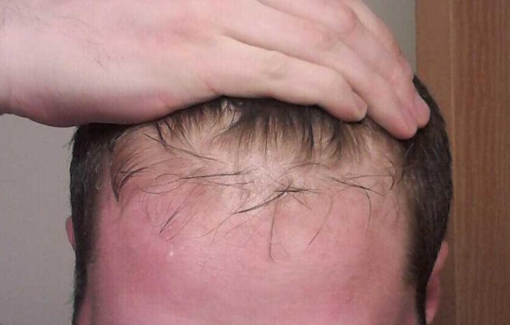 wet_hairline.jpg