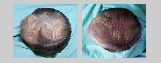 hairloss1.jpg