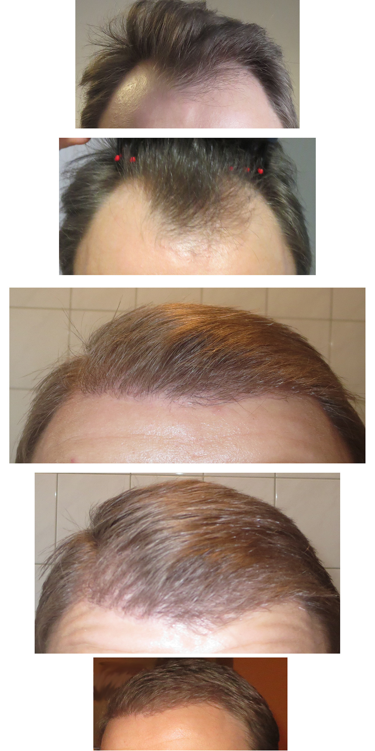 hair5months.jpg